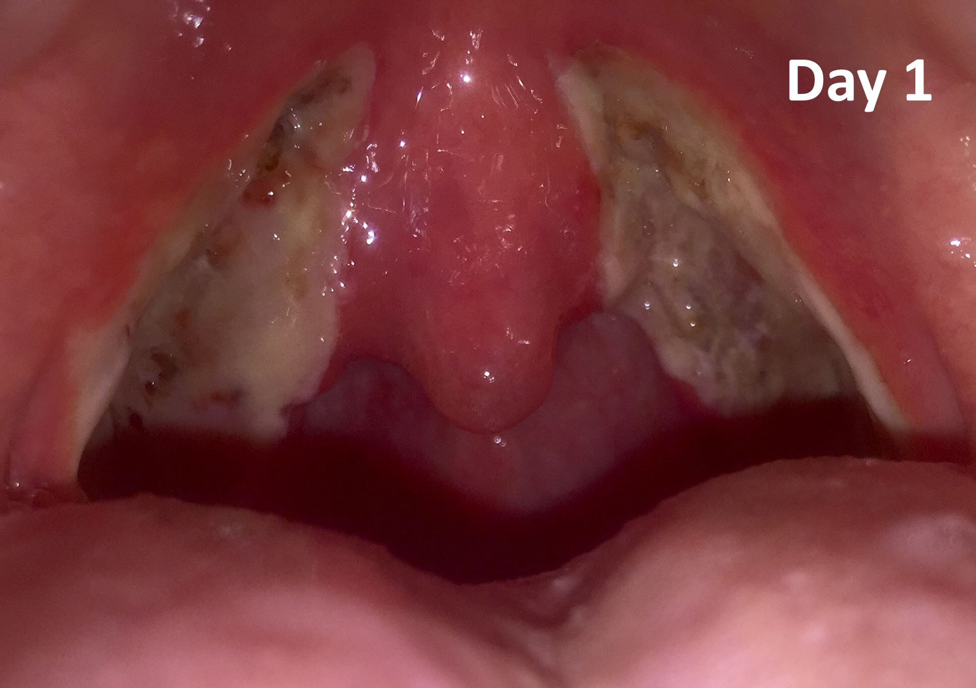 Tonsillectomy Terrors – A Recap (Age 40) and 8 Things I learned