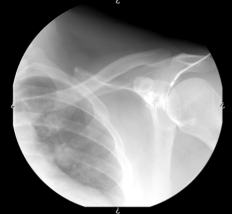 Arthrogram MRI